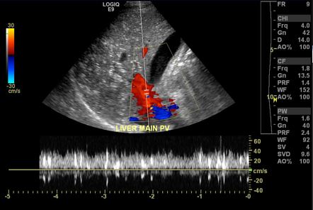 Portal venous gas on ultrasound | Image | Radiopaedia.org