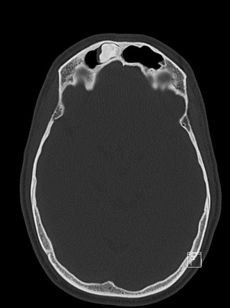 Frontal sinus osteoma | Radiology Case | Radiopaedia.org