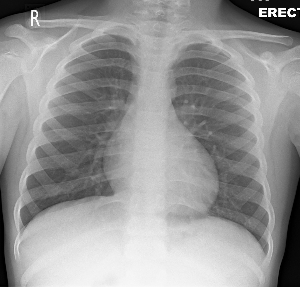 Neat How To Report Normal Chest X Ray Write A Good Introduction For 