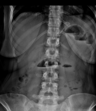 Incarcerated umbilical hernia, Radiology Case