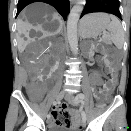 Spontaneous active bleeding into a cyst in autosomal dominant ...