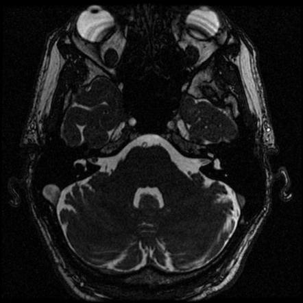 Vestibular schwannoma - intrameatal | Radiology Case | Radiopaedia.org