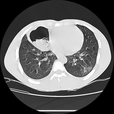 Complicated Pulmonary Hydatid Cyst 