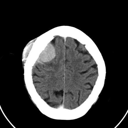 Extradural haemorrhage (summary) | Radiology Reference Article