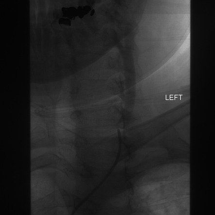 Normal cerebral angiogram (four vessel DSA) | Image | Radiopaedia.org