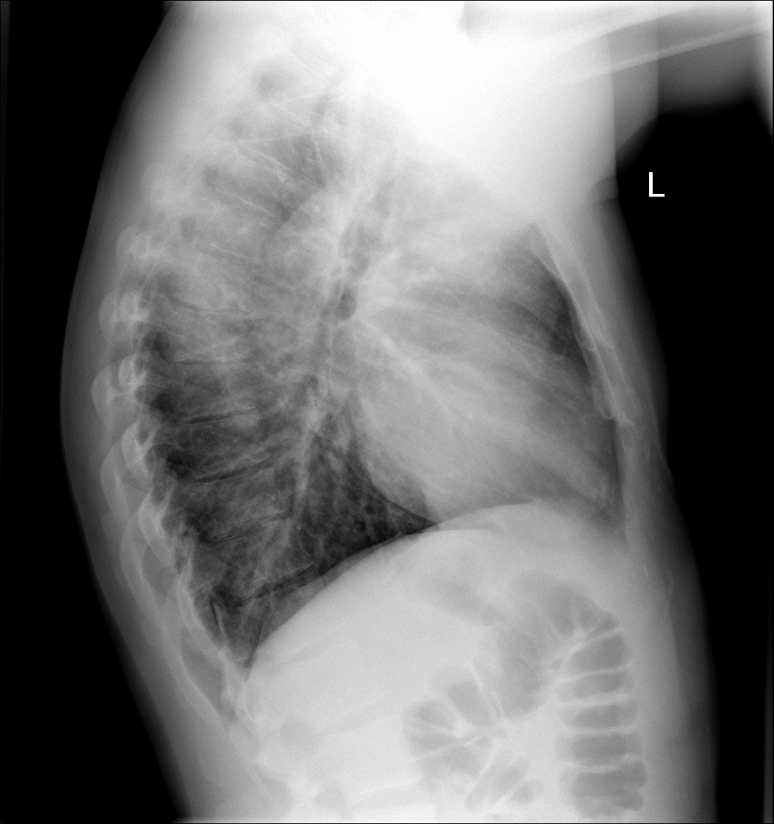 Apical segment left lower lobe consolidation | Image | Radiopaedia.org