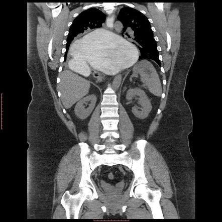 Organo-axial gastric volvulus | Radiology Case | Radiopaedia.org