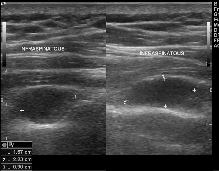 Paralabral cyst of shoulder | Image | Radiopaedia.org