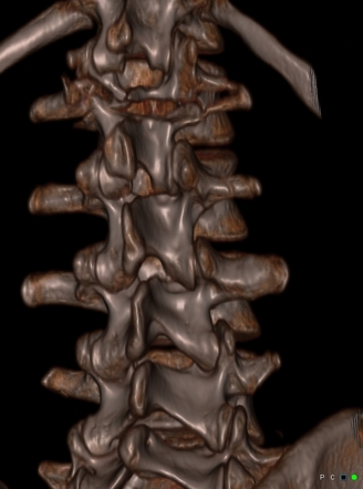 Surgically treated Chance fracture of L1 | Image | Radiopaedia.org