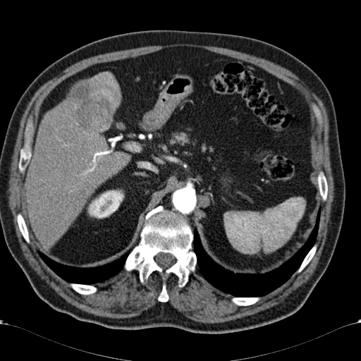 Atypical hepatocellular carcinoma | Image | Radiopaedia.org