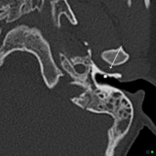 Foreign Body In External Auditory Canal Image 4901