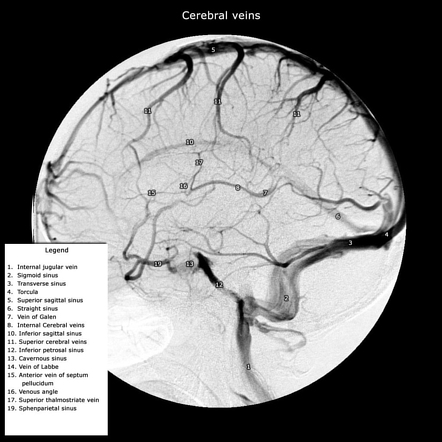 Sigmoid sinus | Radiology Reference Article | Radiopaedia.org