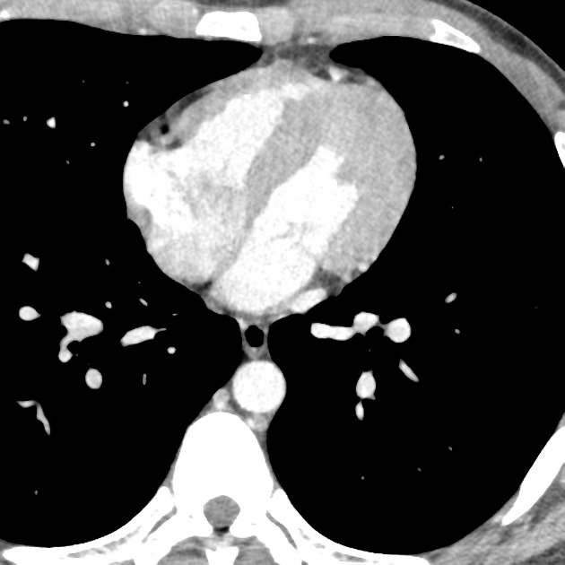 Normal Ct Pulmonary Veins Pre Rf Ablation Radiology Case Radiopaedia Org