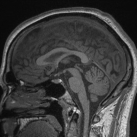 Normal MRI pineal gland | Image | Radiopaedia.org