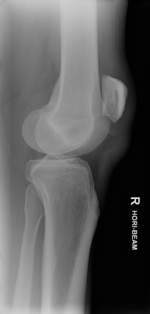 Patellar tendon rupture | Radiology Reference Article | Radiopaedia.org