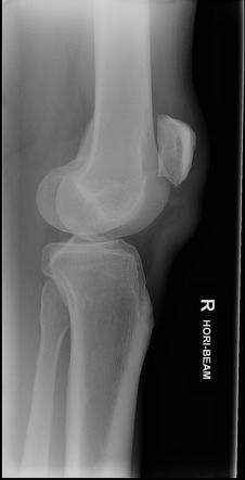 Patellar tendon rupture | Radiology Reference Article | Radiopaedia.org