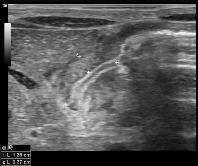 Hypertrophic Pyloric Stenosis Image