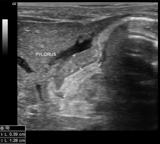 Hypertrophic Pyloric Stenosis Image