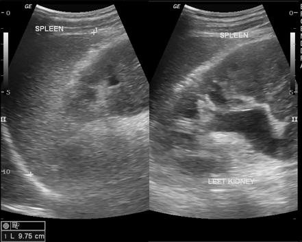 Renal cell carcinoma | Radiology Case | Radiopaedia.org