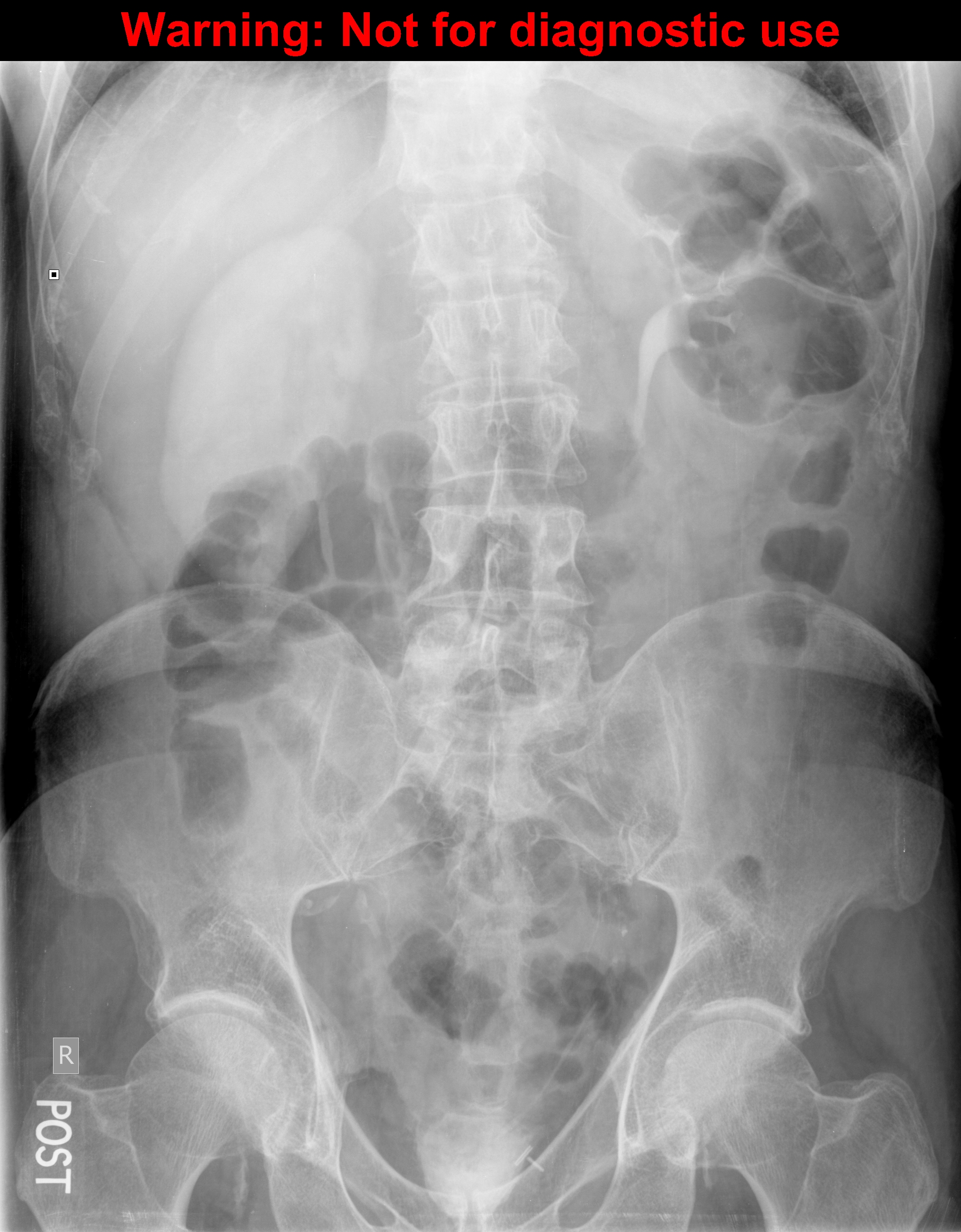 Delayed nephrogram (IVP) | Image | Radiopaedia.org