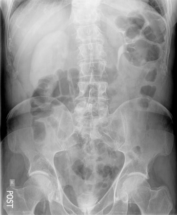 Delayed nephrogram | Radiology Reference Article | Radiopaedia.org