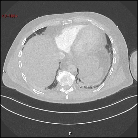 Punctured right ventricle by pacemaker lead | Radiology Case ...