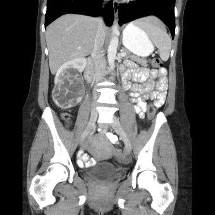 Renal cell carcinoma | Radiology Reference Article | Radiopaedia.org