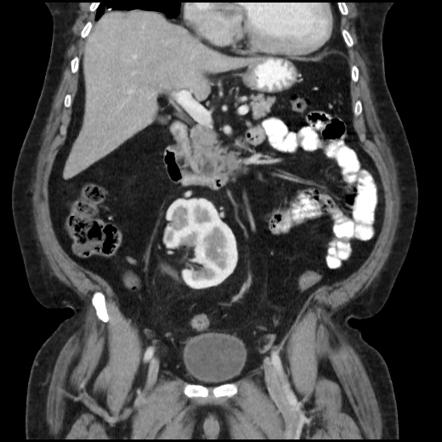 Crossed lumbar dystopia of the left kidney | Radiology Case ...