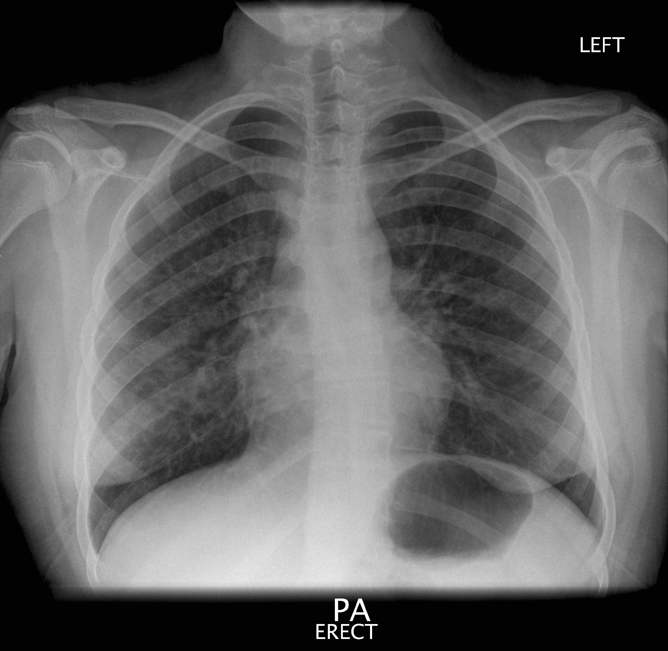 Hypersensitivity Pneumonitis | Image | Radiopaedia.org