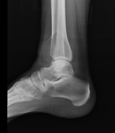 Viewing playlist: MRI Ankle | Radiopaedia.org