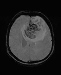 File:Oligodendroglioma (IDH-mt, 1p19q codeleted) (Radiopaedia 41807 ...