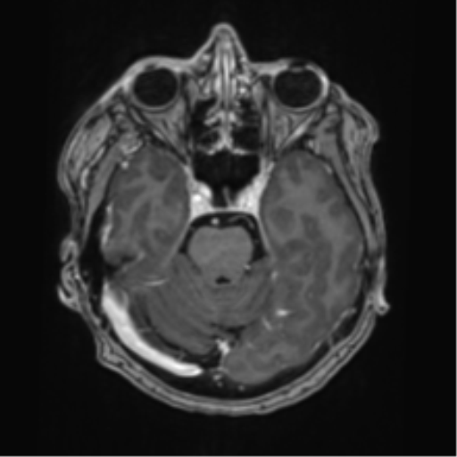 File:Oligodendroglioma (IDH-mt, 1p19q codeleted) (Radiopaedia 41807 ...