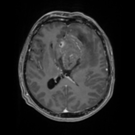 Oligodendroglioma (IDH-mt, 1p19q codeleted) | Image | Radiopaedia.org