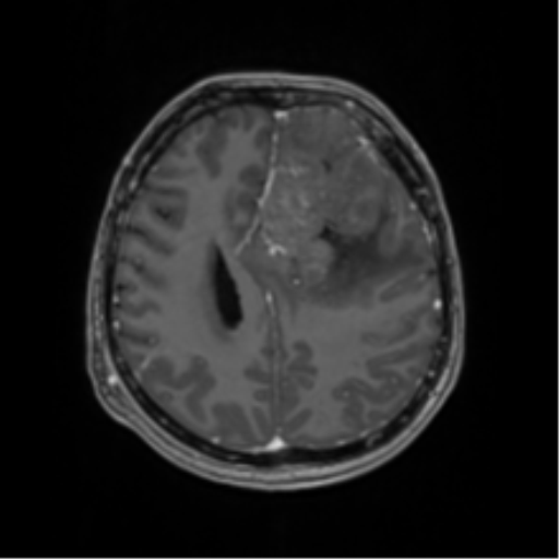 File:Oligodendroglioma (IDH-mt, 1p19q codeleted) (Radiopaedia 41807 ...