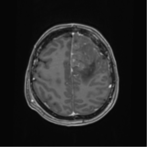 File:Oligodendroglioma (IDH-mt, 1p19q codeleted) (Radiopaedia 41807 ...