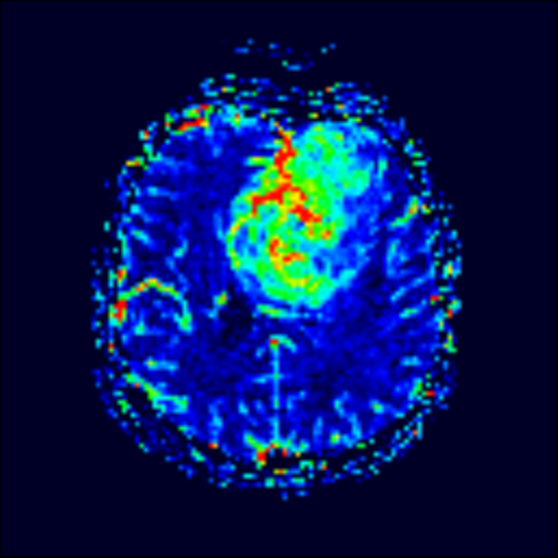 File:Oligodendroglioma (IDH-mt, 1p19q codeleted) (Radiopaedia 41807 ...