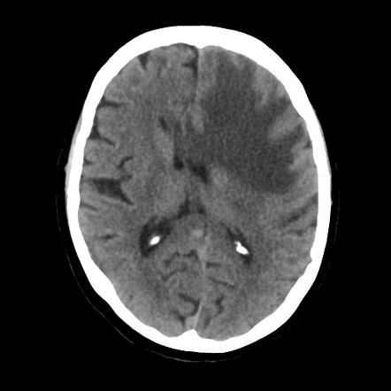 Brain metastasis (extensive vasogenic edema) | Image | Radiopaedia.org