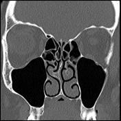 Tag: nasal septum spur | Radiopaedia.org