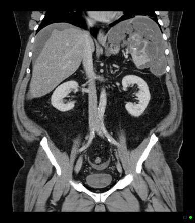 Pseudomyxoma peritonei - appendiceal origin | Image | Radiopaedia.org