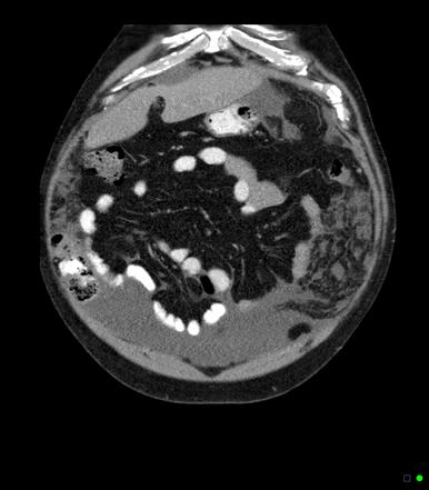 Pseudomyxoma Peritonei - Appendiceal Origin | Image | Radiopaedia.org