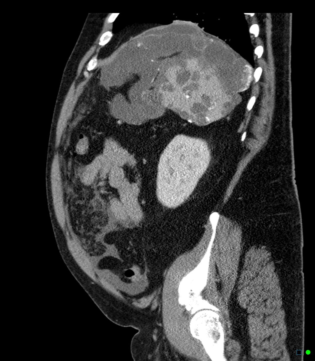 Pseudomyxoma Peritonei Appendiceal Origin Image Radiopaedia Org