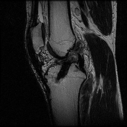 Anterior cruciate ligament graft tear, Radiology Case