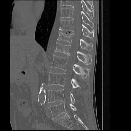 Insufficiency fracture | Radiology Reference Article | Radiopaedia.org