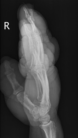 Thyroid acropachy | Image | Radiopaedia.org