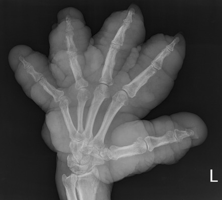 Finger clubbing | Radiology Reference Article | Radiopaedia.org