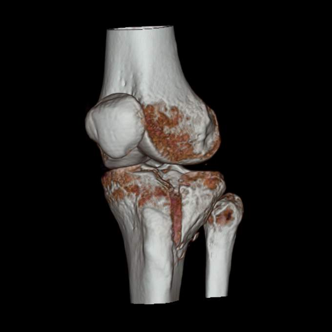 Tibial Plateau Fracture: Schatzker Type II | Image | Radiopaedia.org