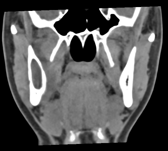 Keratocystic Odontogenic Tumor Image 4341