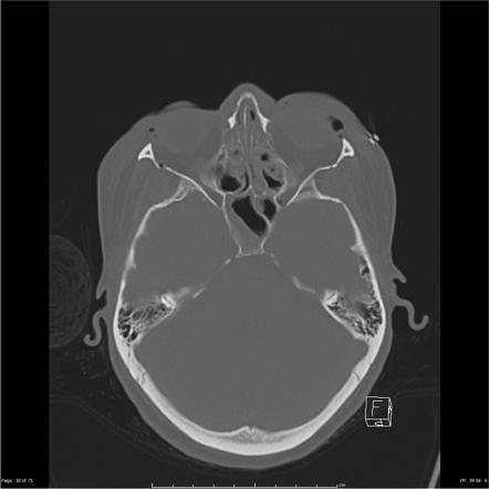 Le Fort fractures | Image | Radiopaedia.org