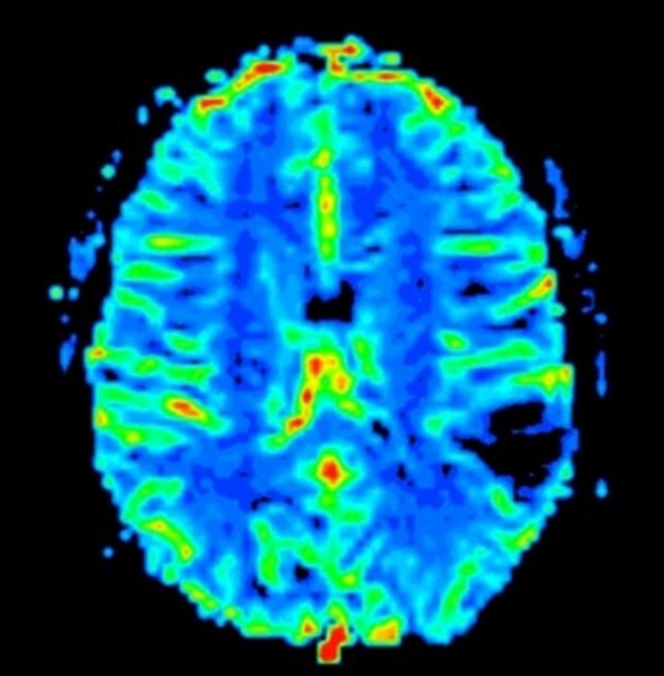 Diffuse Astrocytoma Nos 