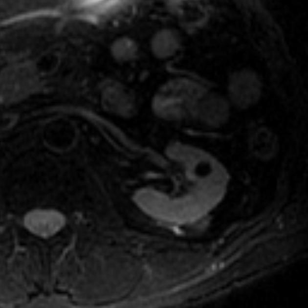 Atypical Renal Cyst On Mri Radiology Case Radiopaedia Org